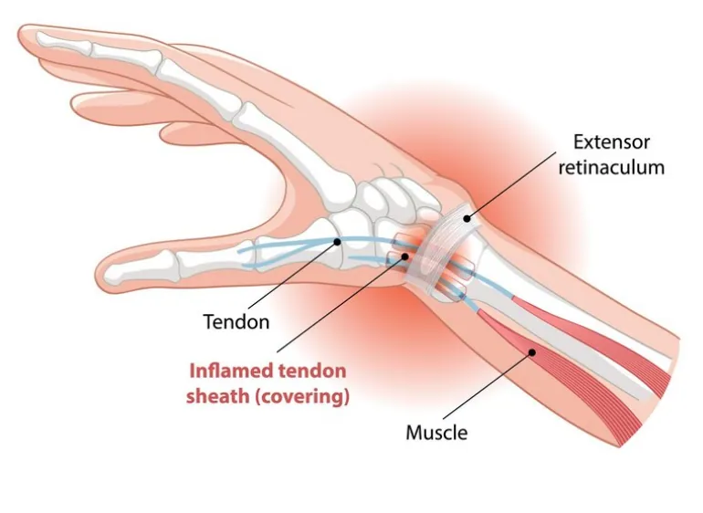 From Pain to Progress: Chiropractic Care for Carpal Tunnel Relief
