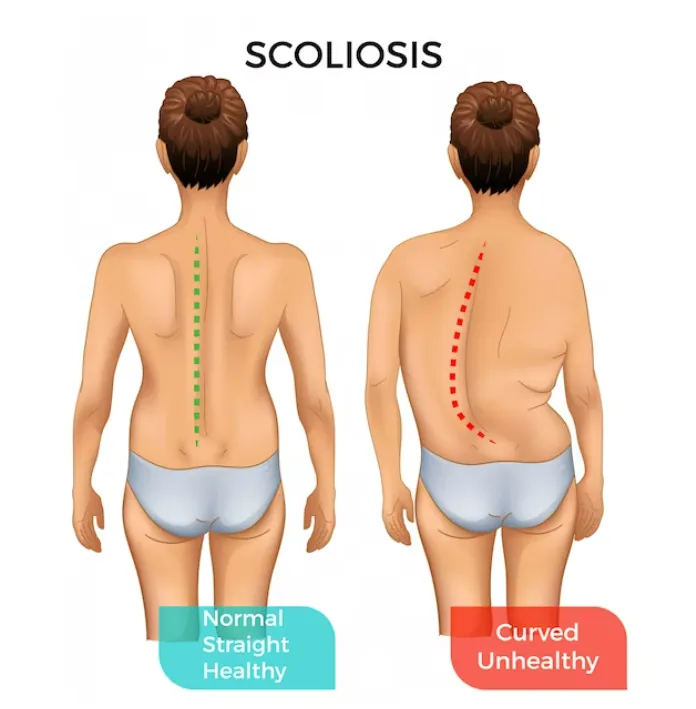 Scoliosis and Posture: Tips for Maintaining a Healthy Spine