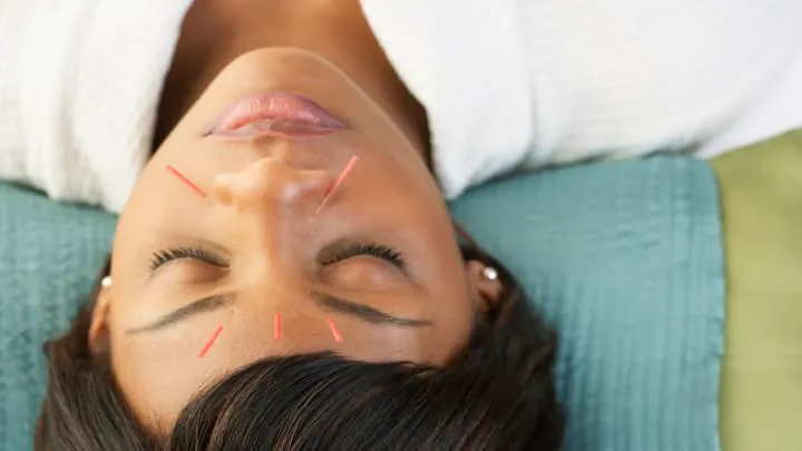 Acupuncture at Catalyst Chiropractic And Rehab in Blaine, MN