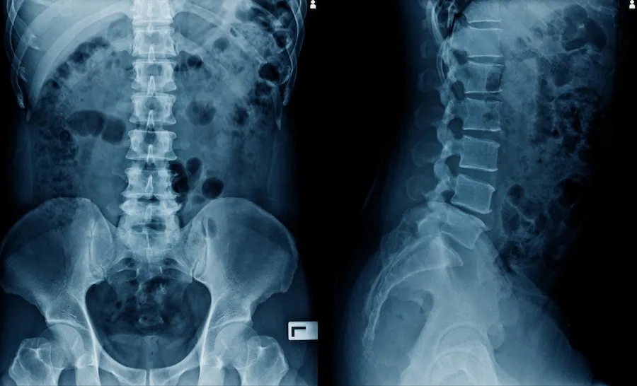 Spine X-Ray at Catalyst Chiropractic And Rehab in Blaine, MN
