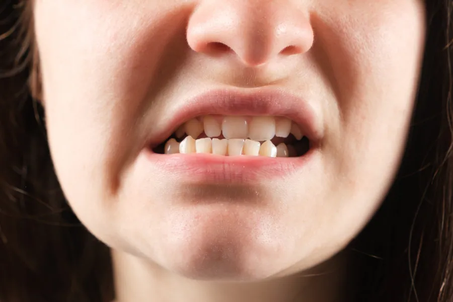 TMD/TMJ at Catalyst Chiropractic And Rehab in Blaine, MN